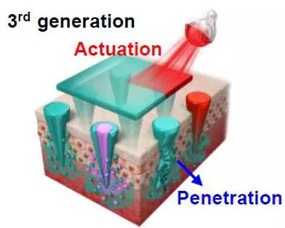 第三代：通过微针介导的皮肤层破损和微针陪同的种种功效增强药物转运.jpg